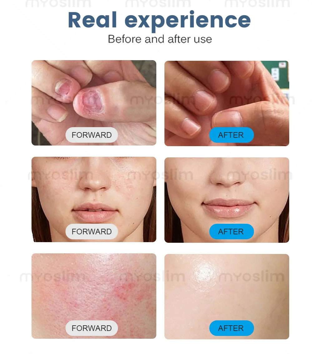 Myoslim Dual Wavelength Diode Laser Skin Rejuvenation Device